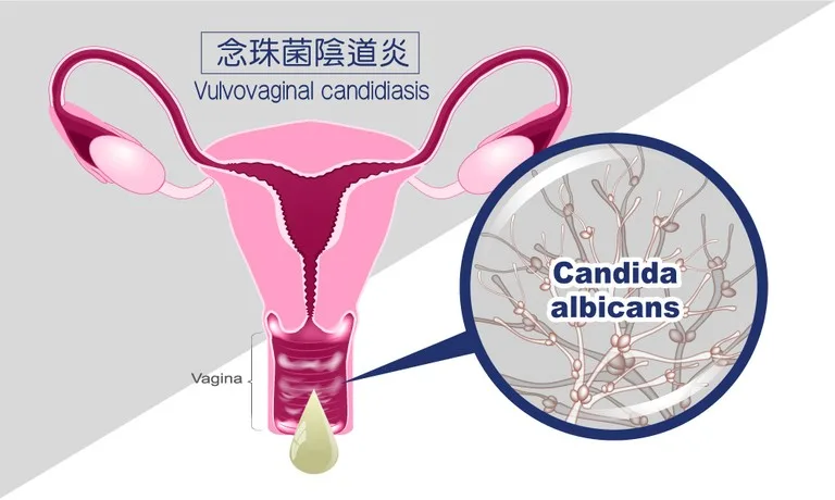 Candida albicans 陰道發炎 